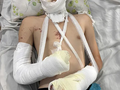 Pháo nổ làm nát hai bàn tay, nát mặt nam thanh niên: Cảnh báo nhiều nhưng vẫn thờ ơ