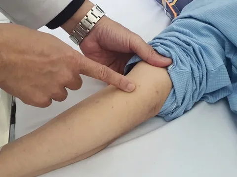 Nhiễm não mô cầu có thể tử vong trong 24h