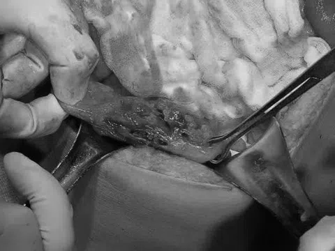 Phẫu thuật cấp cứu thành công ca bệnh vỡ đại tràng sigma do tai nạn giao thông