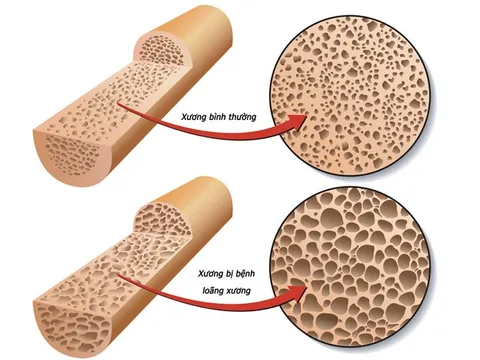 Thiếu vitamin D: "Căn bệnh âm thầm" dễ bị bỏ qua