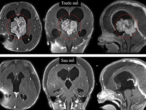 Bác sĩ cảnh báo dấu hiệu cần nhập viện ngay khi bé sơ sinh bị u não