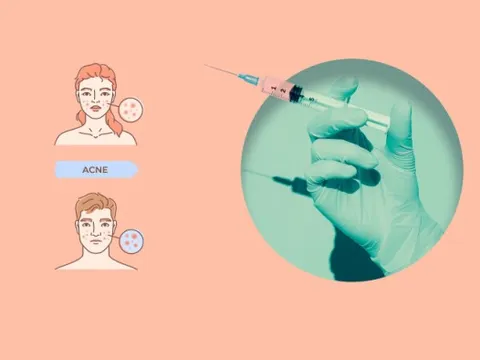Vaccine trị mụn đầu tiên của thế giới đi vào thử nghiệm lâm sàng