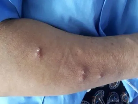 Người phụ nữ ở Sài Gòn nhiễm "vi khuẩn ăn thịt người"