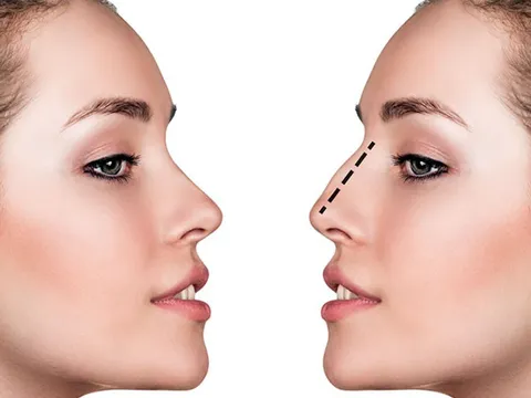 Khi giới trẻ đổ xô phẫu thuật thẩm mỹ đầu năm để “đổi vận”